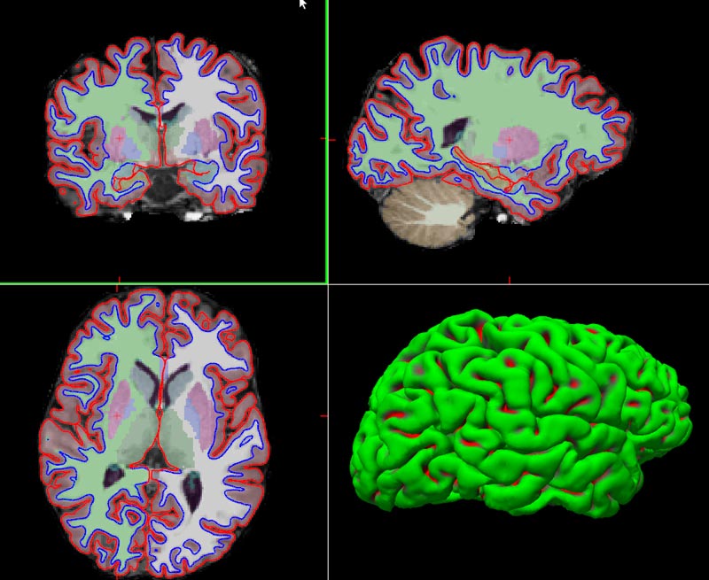 Fig. Segmentation of subcortical structures